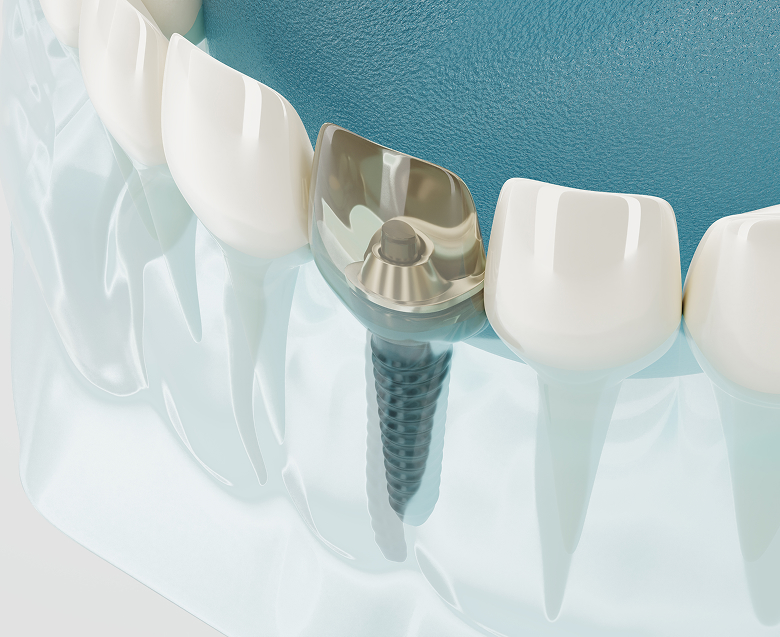 Современные методы имплантации зубов